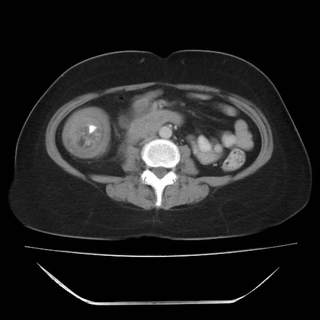 Intussusception of the intestines, CT scan