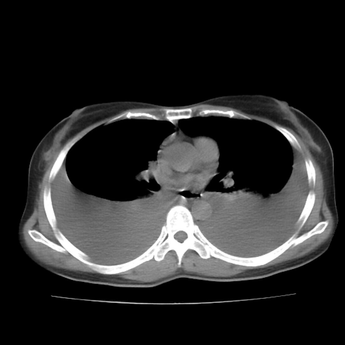 Pleural effusion, CT scan