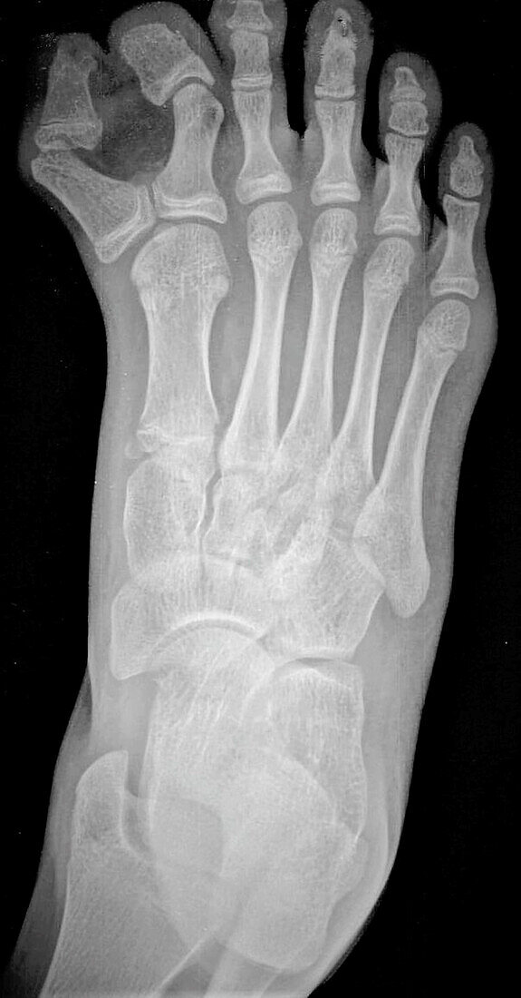 Extra toe, X-ray