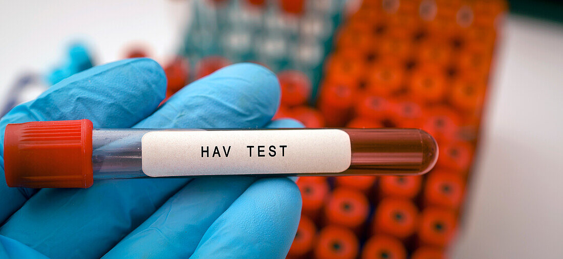 Hepatitis A virus blood test, conceptual image