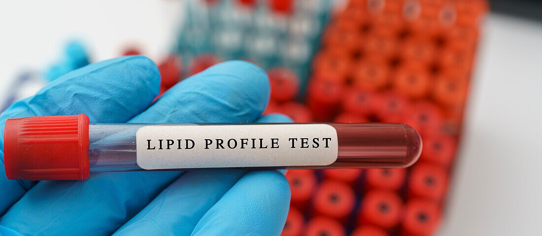 Lipid profile test, conceptual image