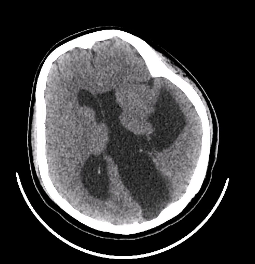 Schizencephaly brain deformity, CT scan