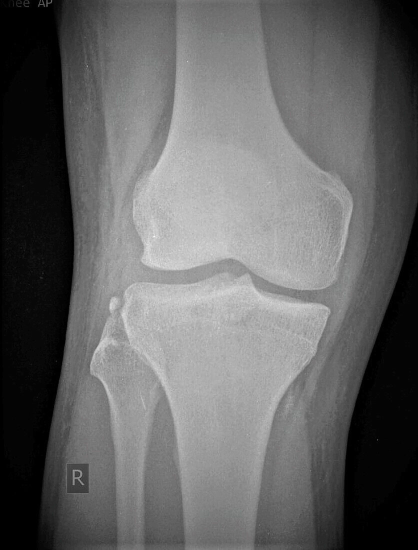 Segond fracture, X-ray