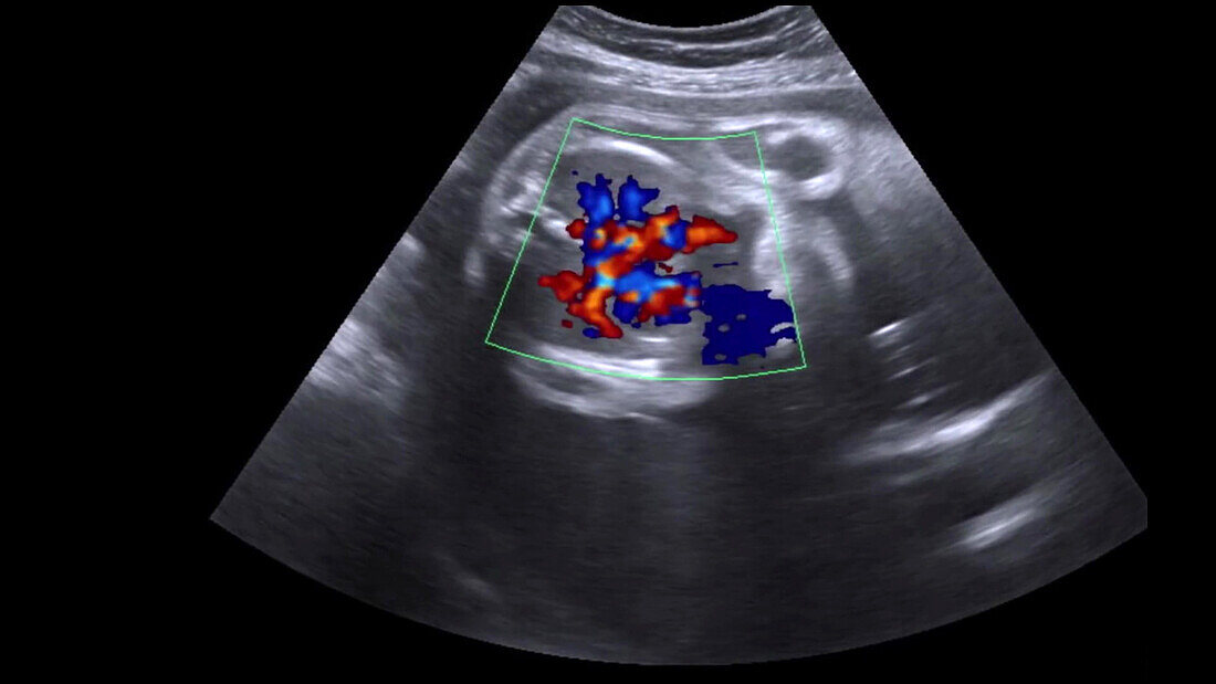 Foetal heart, ultrasound scan