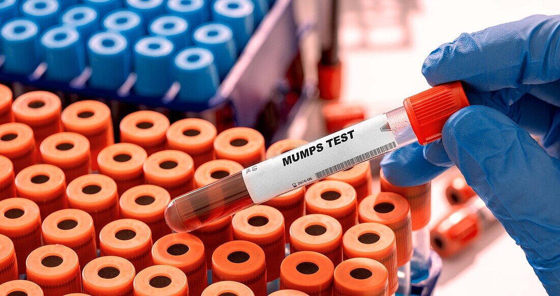 Mumps blood test, conceptual image