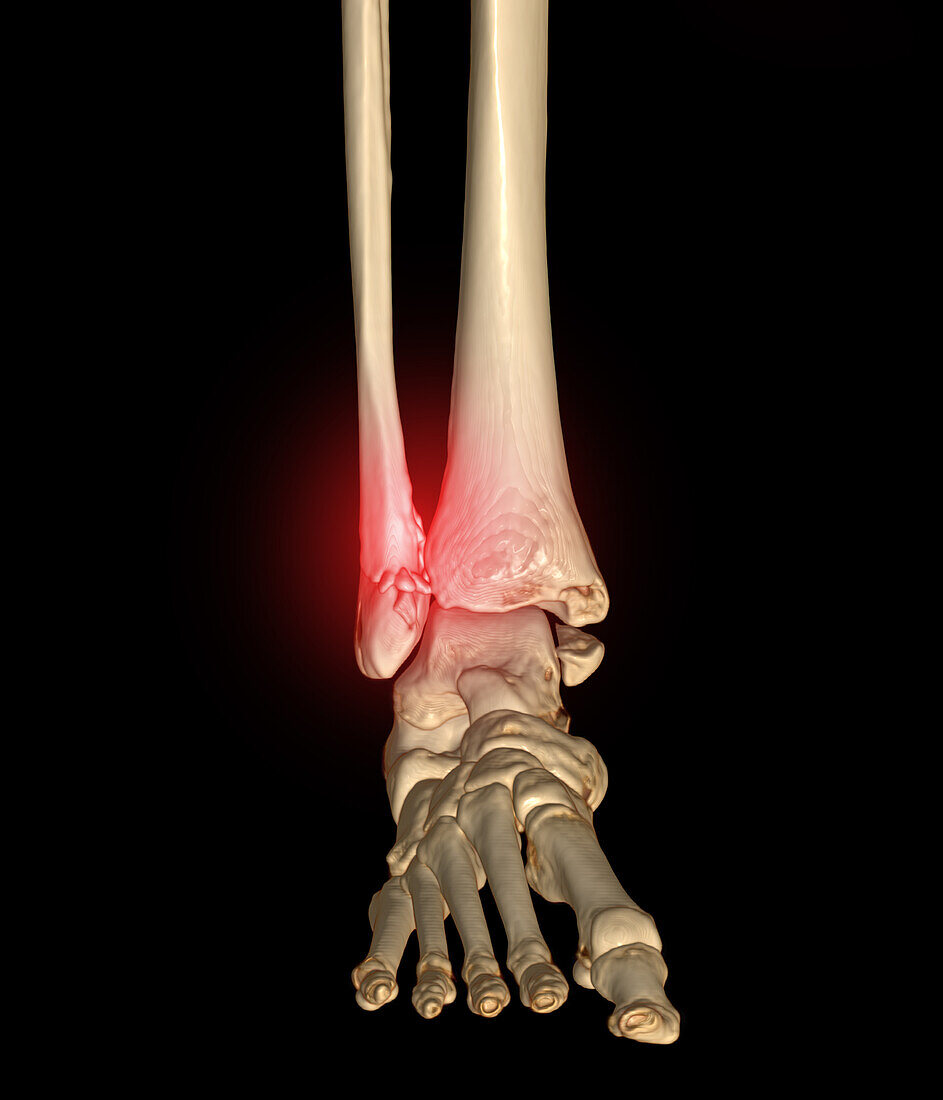 Broken ankle, CT scan
