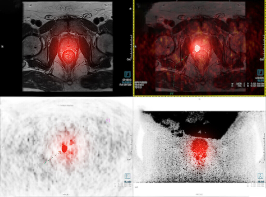 Prostate cancer, PET and MRI scans