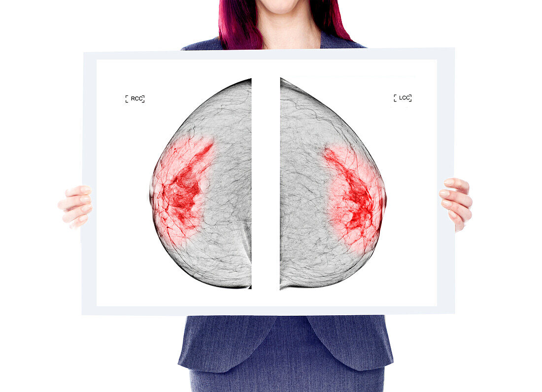 Breast cancer screening, conceptual image