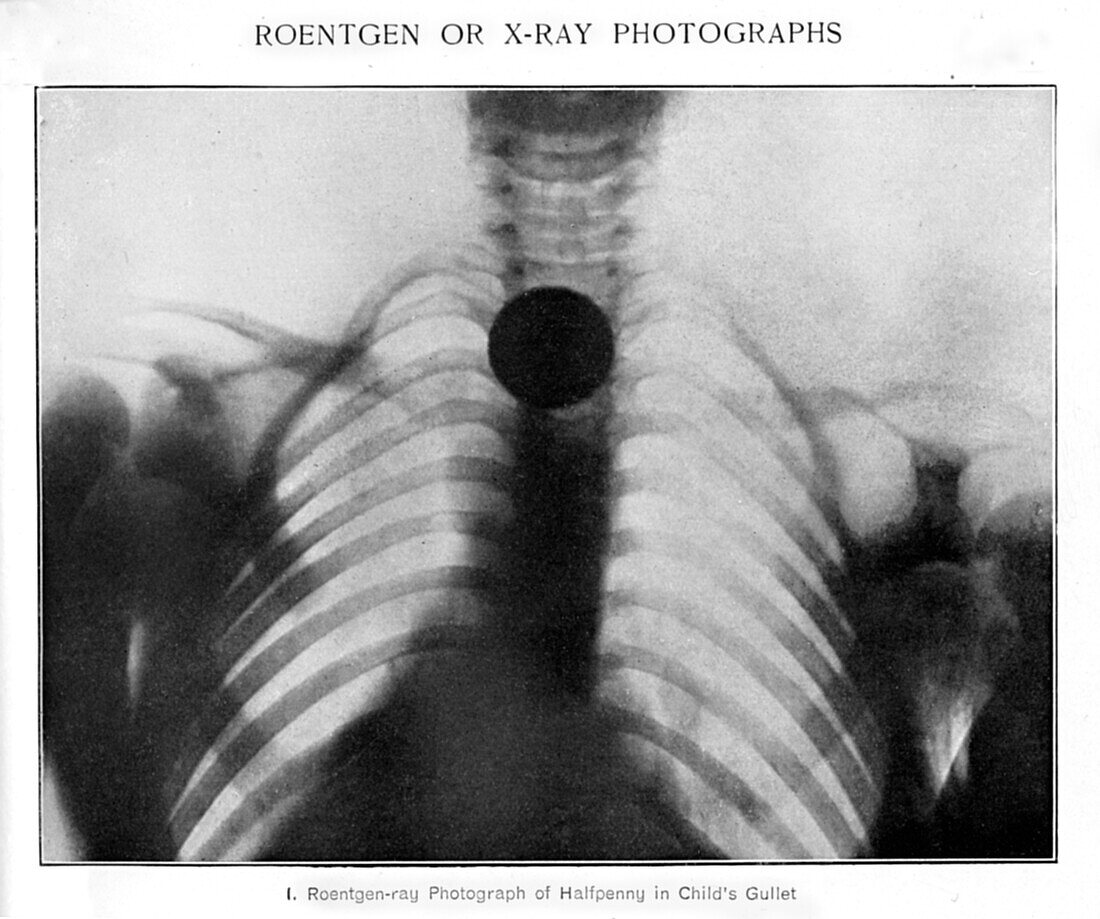 Roentgen-ray photograph