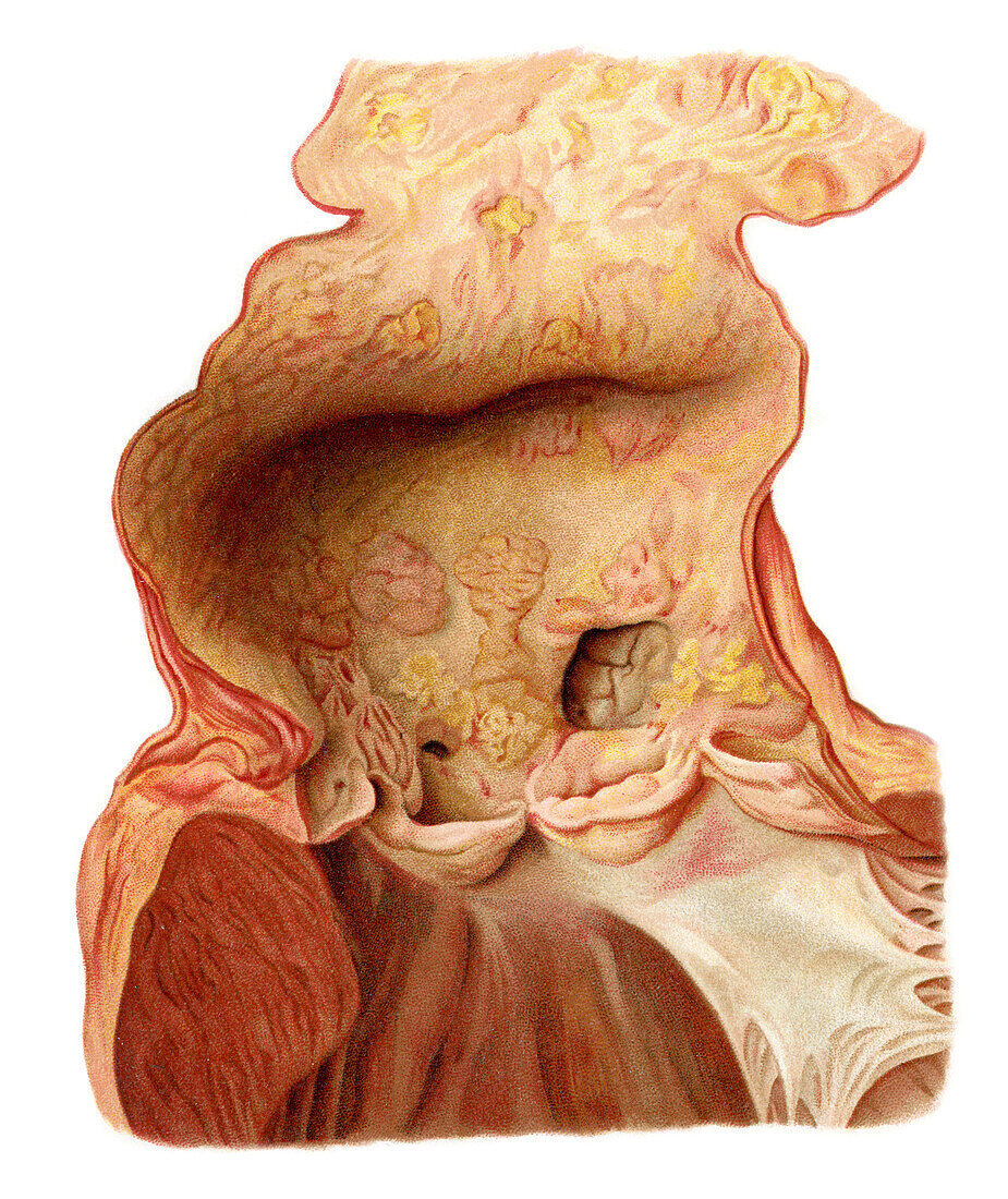 Aortic sclerosis, illustration