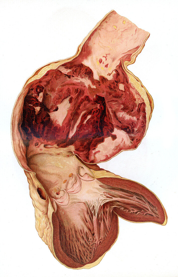 Aortic aneurysm, illustration