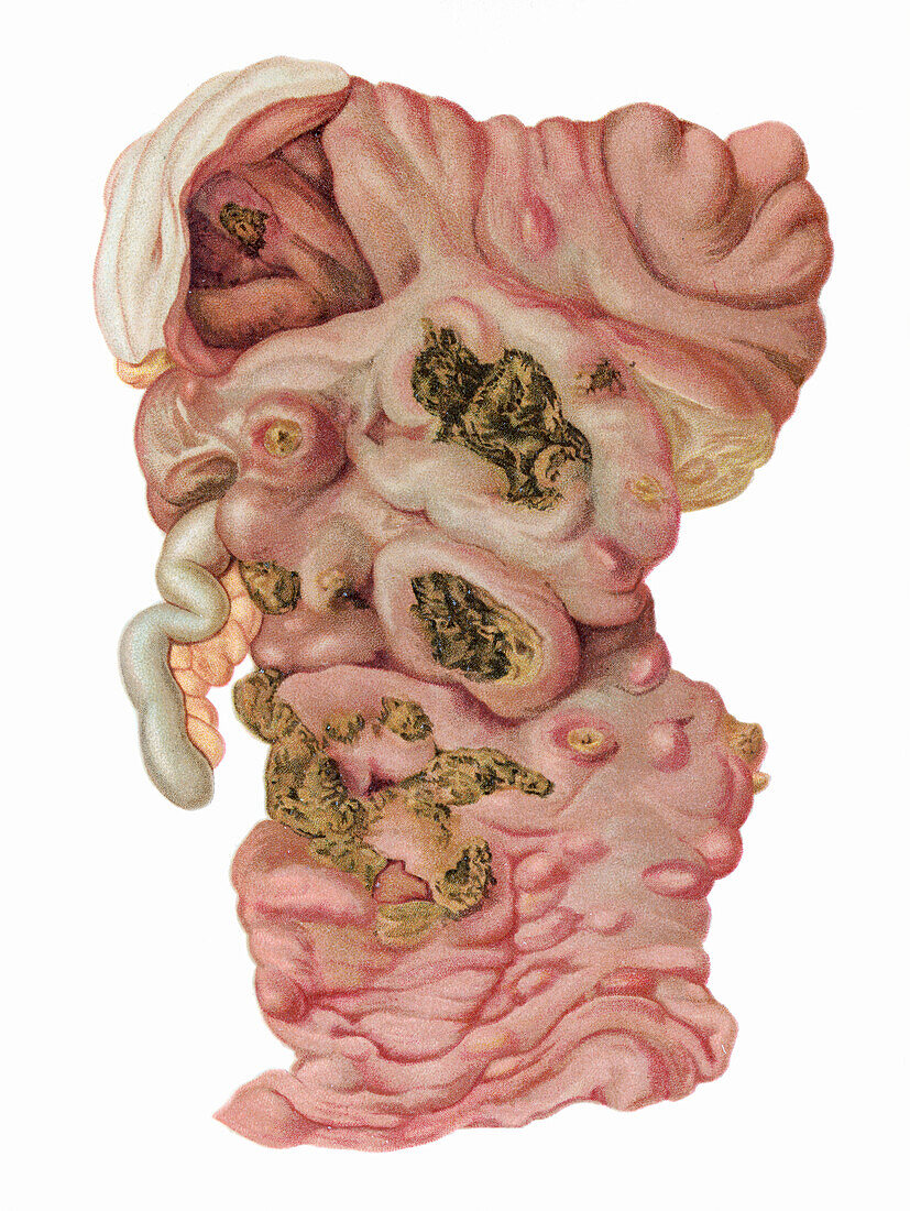 Typhoid fever, illustration