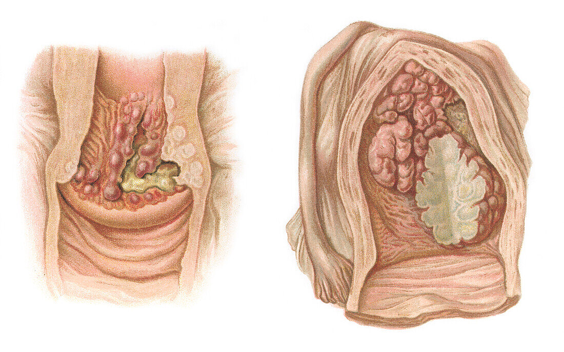 Cervical and uterine cancers, illustration