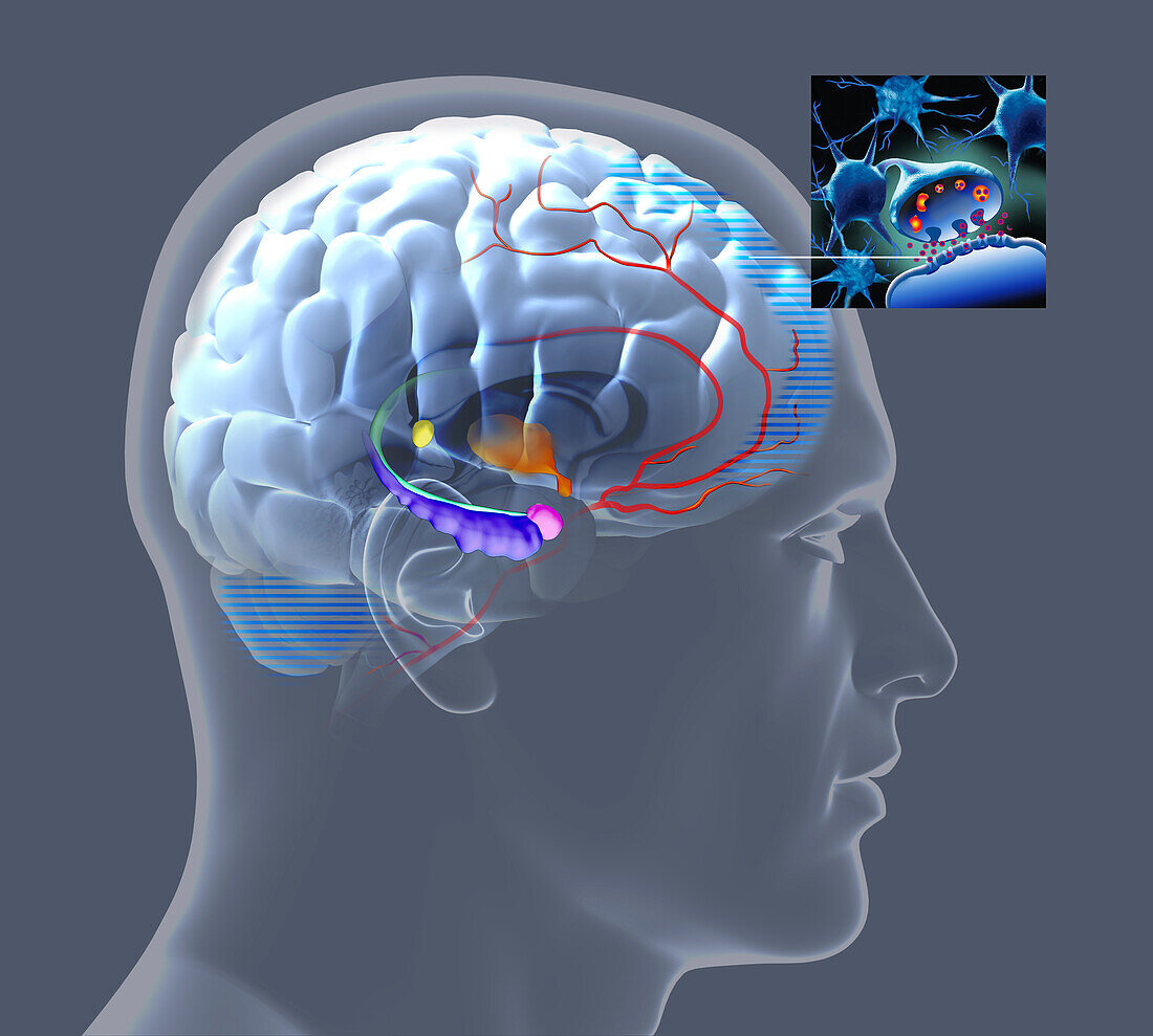 Effects of sport on brain in Alzheimer's disease, illustration