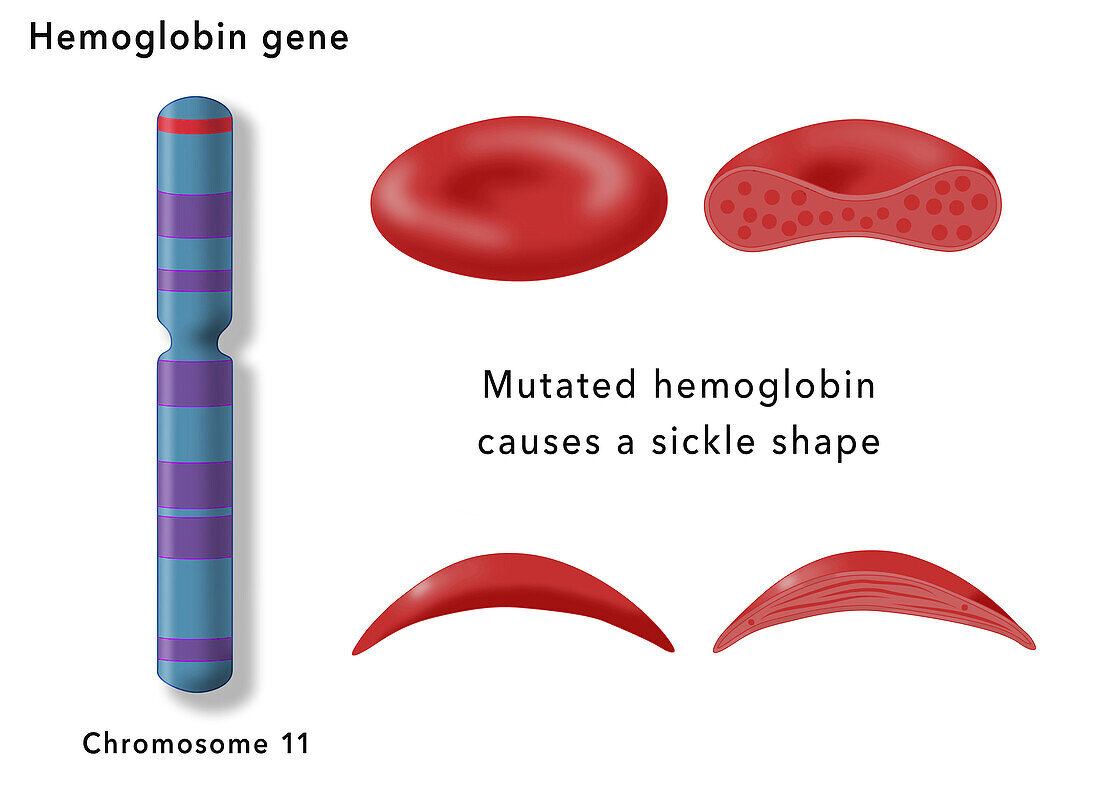 Sickle cell disease, illustration