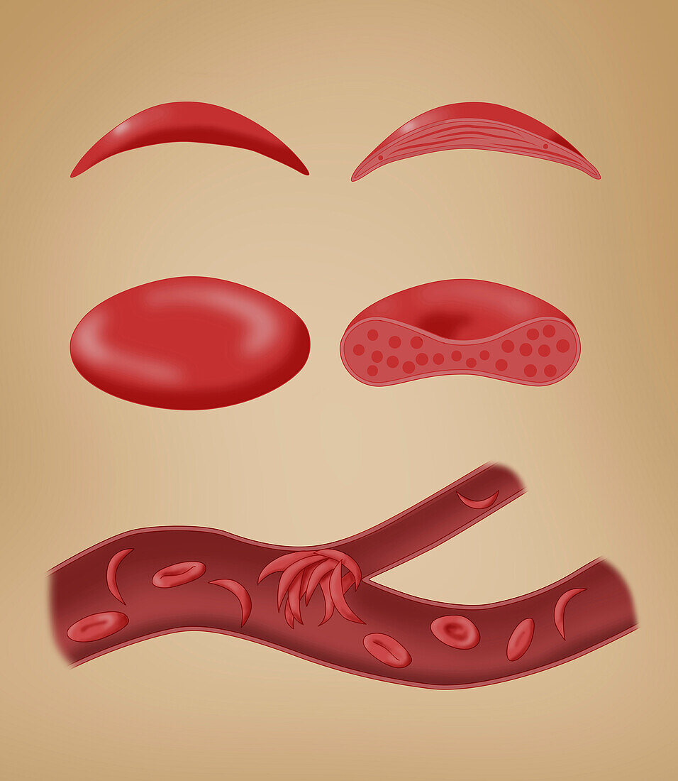 Normal blood cell and sickle cell disease, illustration