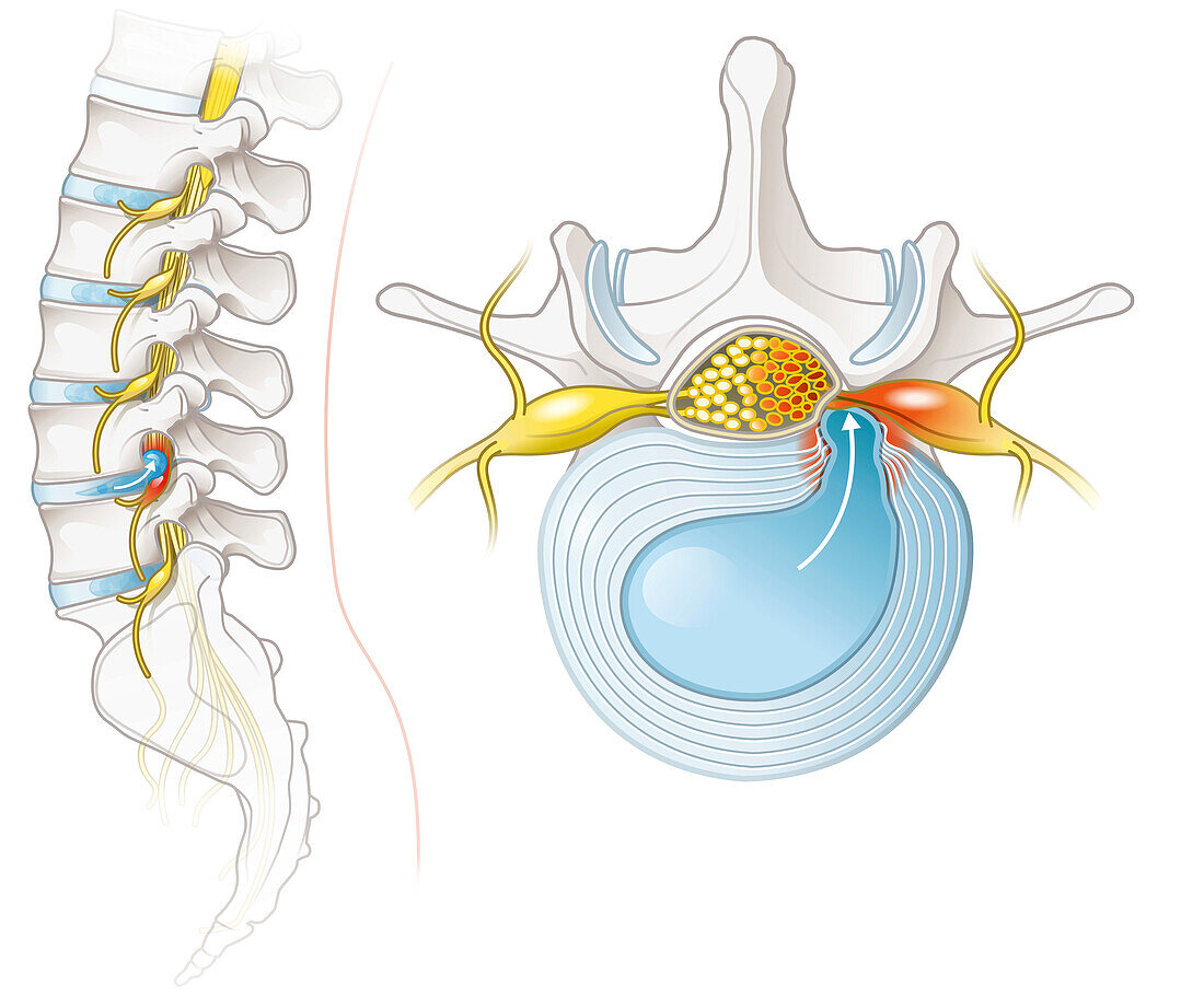 Herniated disc of the lumbar spine, illustration
