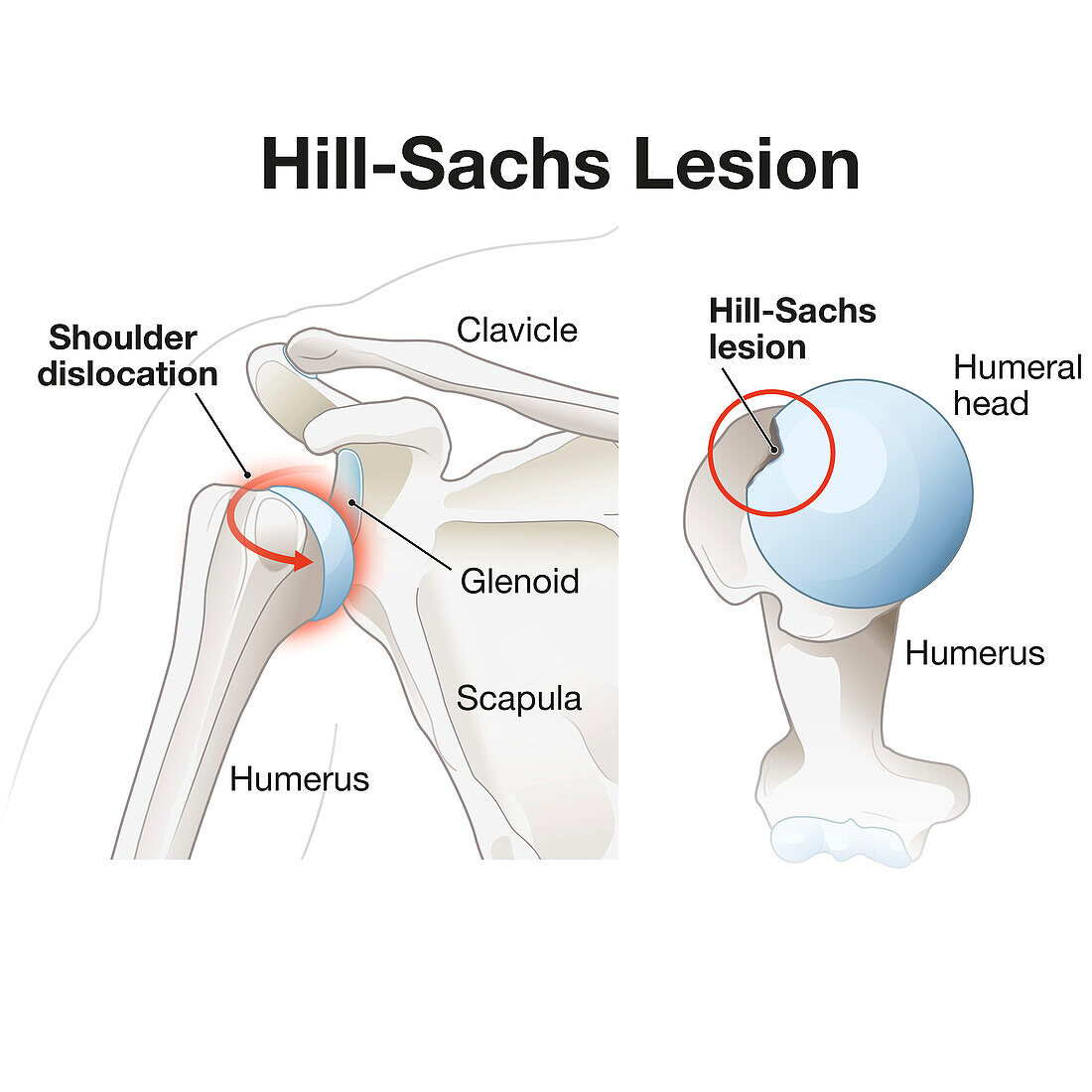 Hill-Sachs lesion of the shoulder, illustration