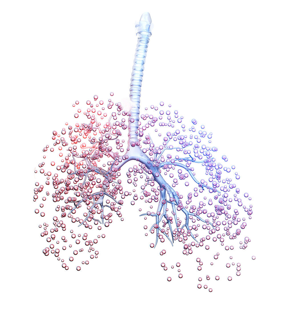 Lung carcinoma, illustration