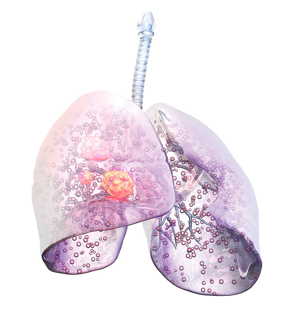 Lung carcinoma, illustration