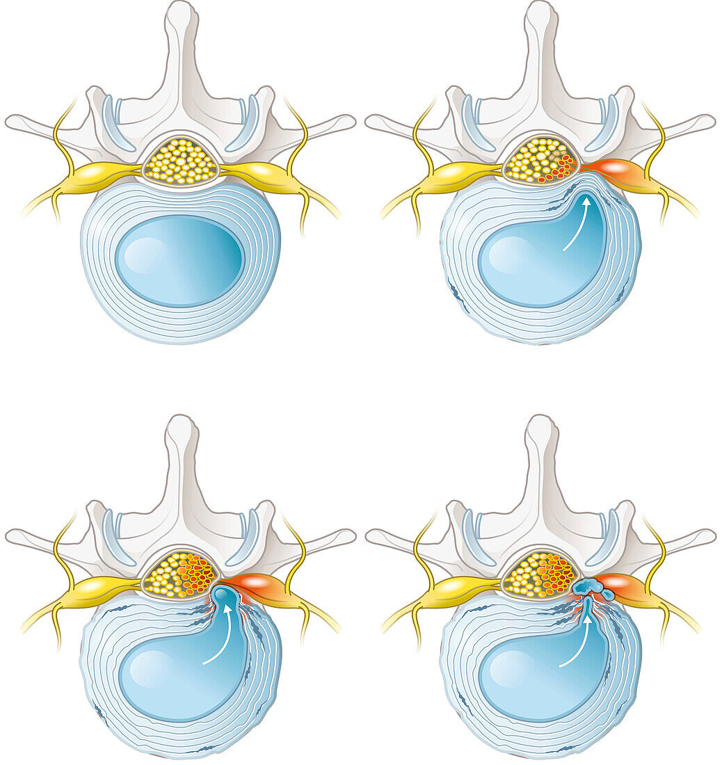 Herniated disc progression, illustration