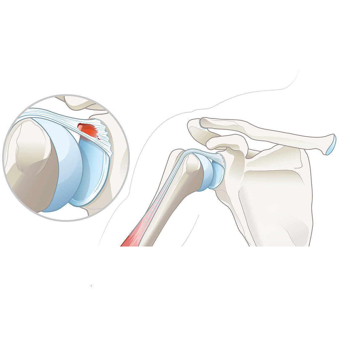 SLAP lesion of the shoulder, illustration