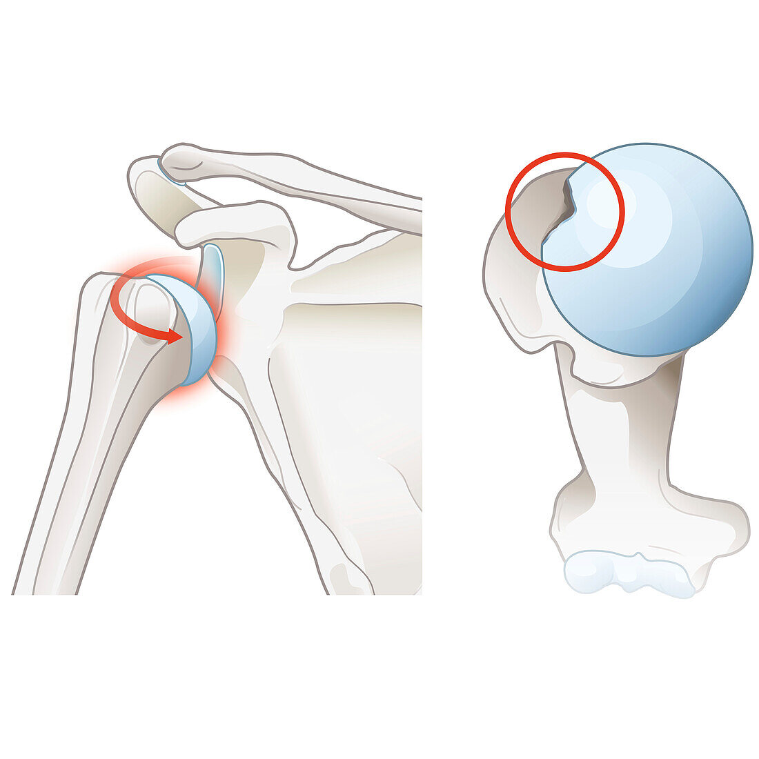 Subacromial bursitis of the shoulder, illustration