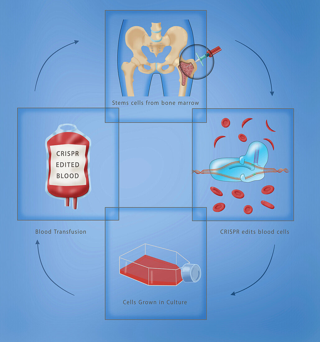 CRISPR sickle cell disease treatment, illustration