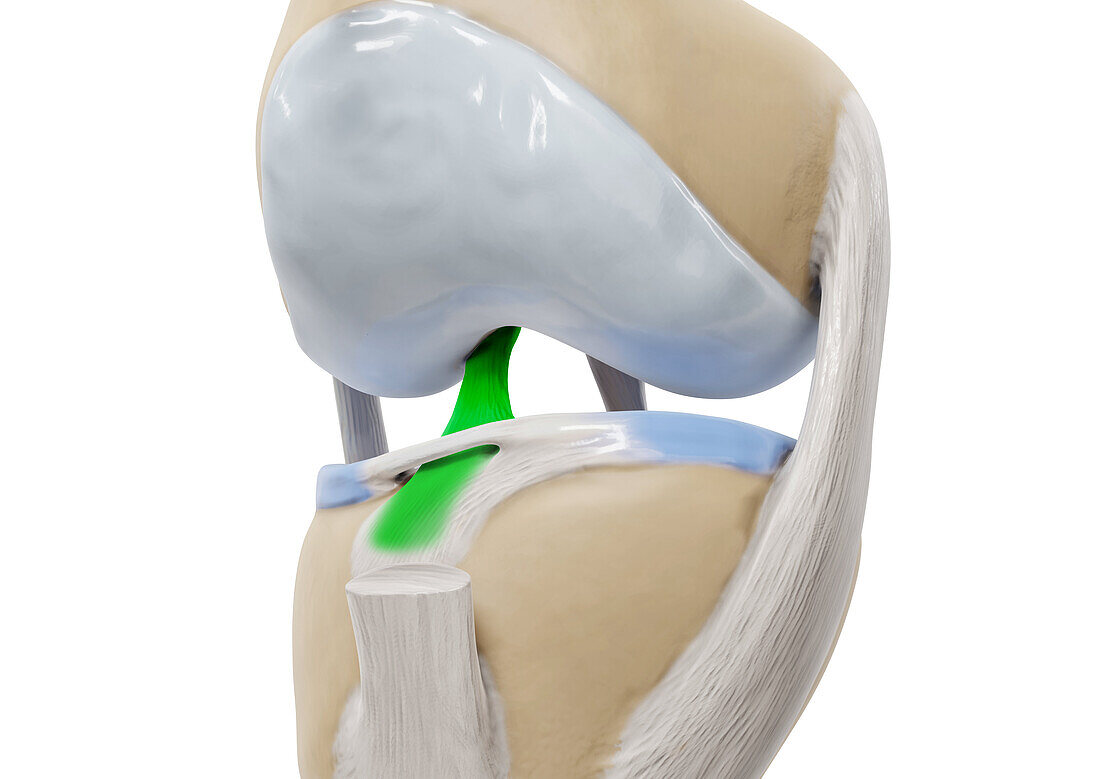 Anterior cruciate ligament without patella, illustration
