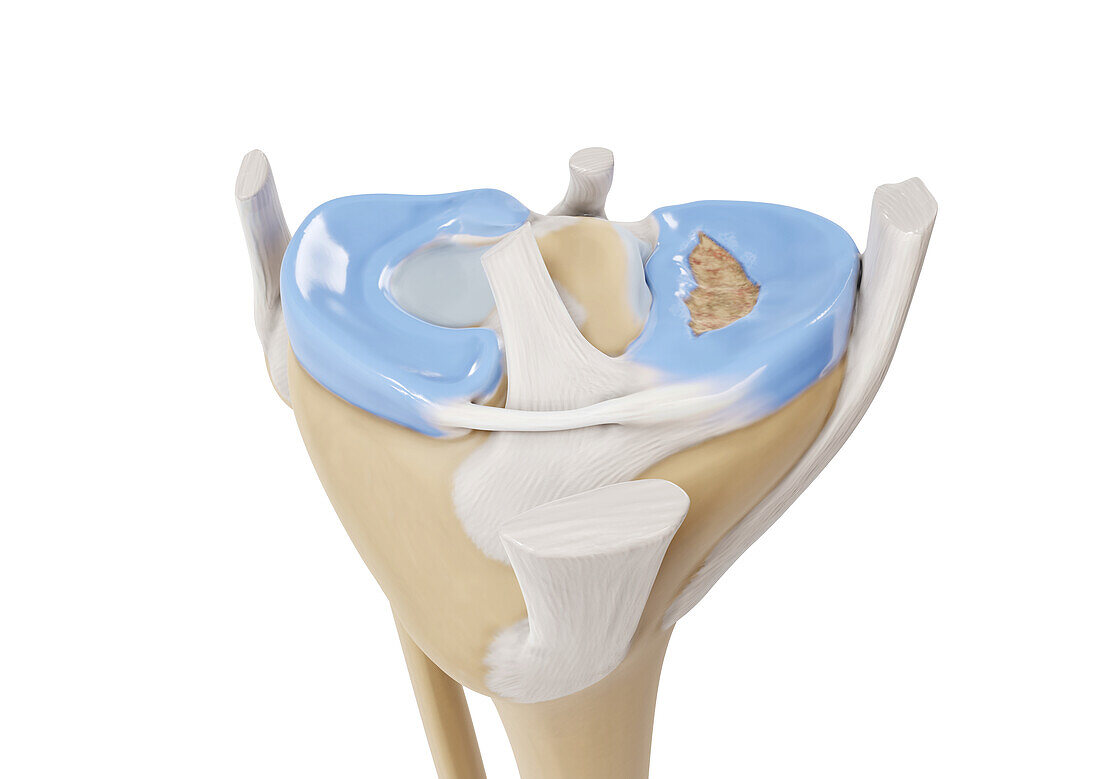 Bucket handle tear meniscus, illustration