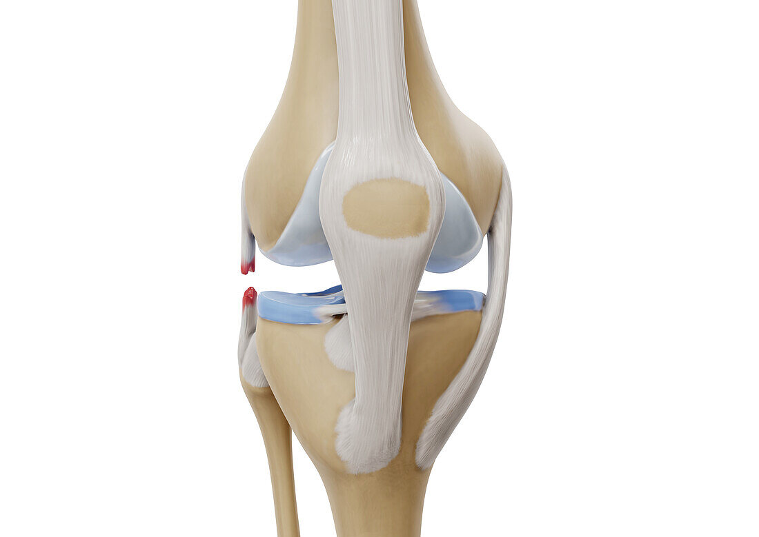 Lateral collateral ligament tear, illustration