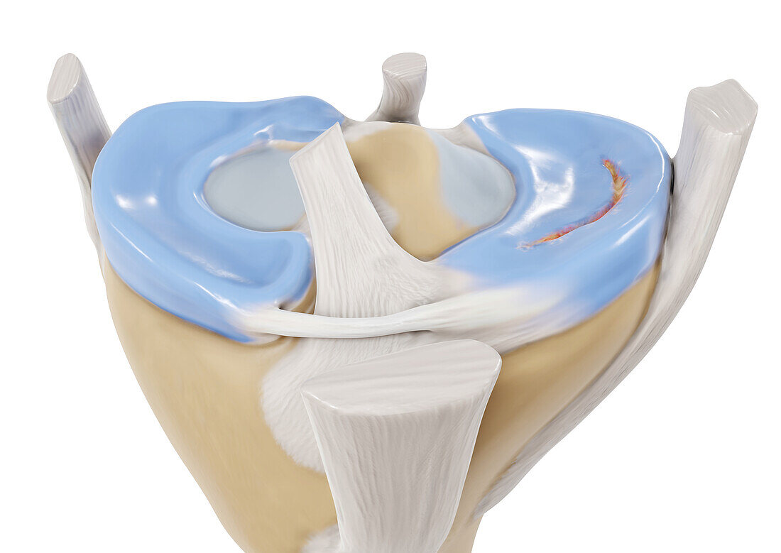 Longitudinal tear meniscus, illustration