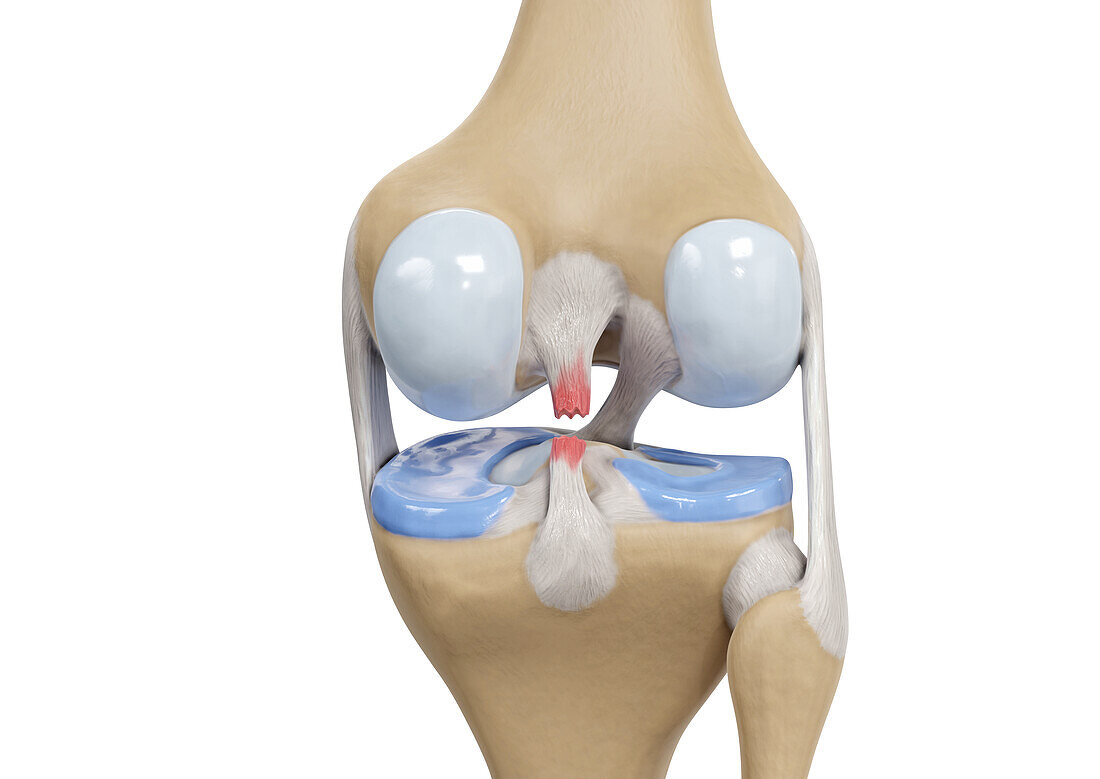 Posterior cruciate ligament tear, illustration