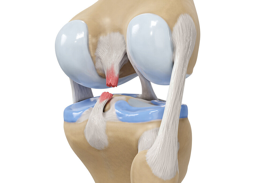 Posterior cruciate ligament tear, illustration