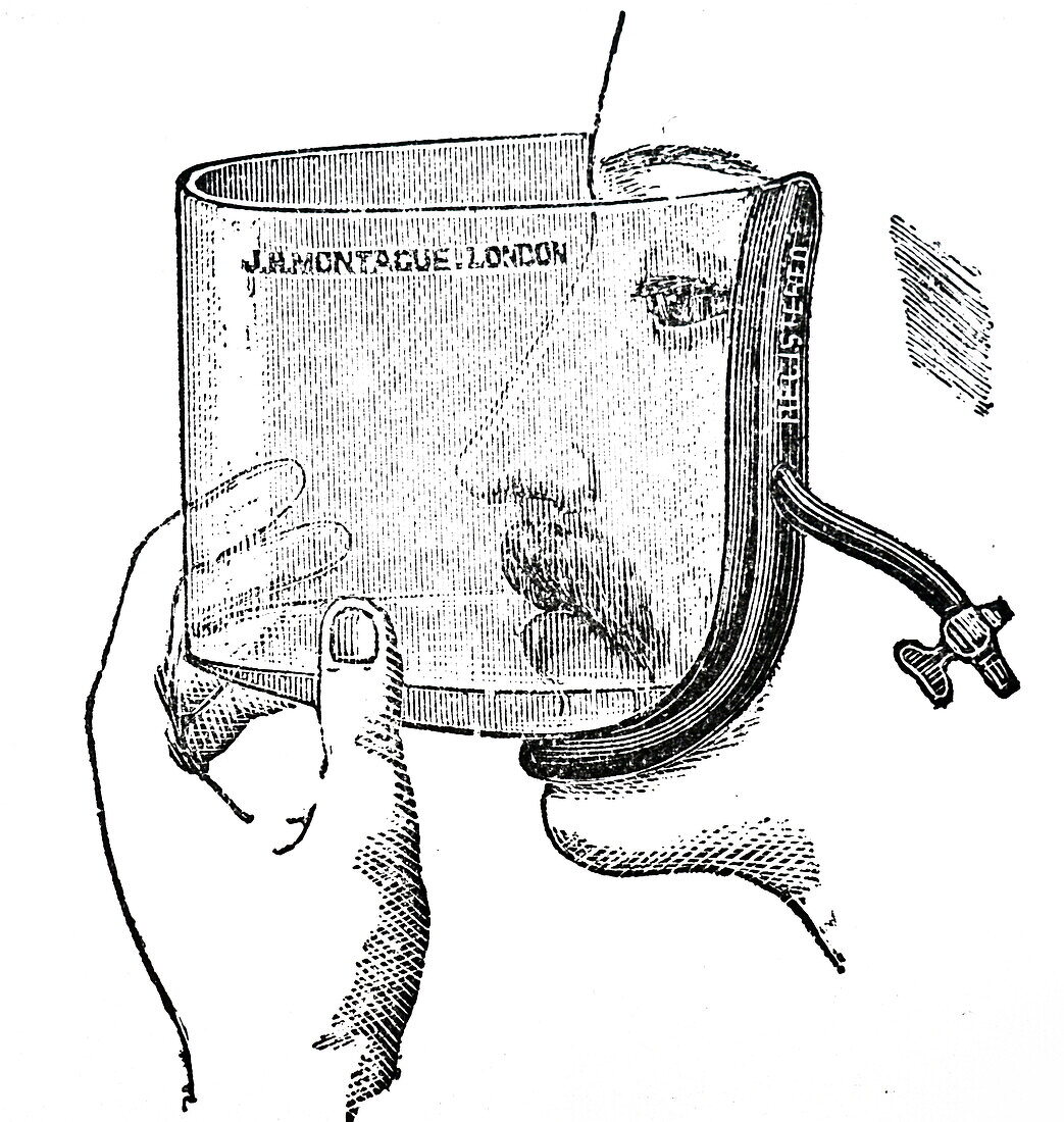 Flux's open method of establishing anaesthesia, illustration