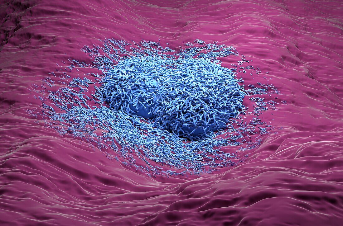 Liver cancer cells, illustration