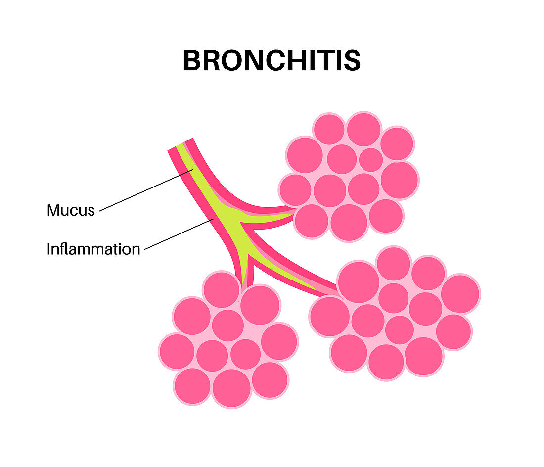 Bronchitis lung disease, illustration