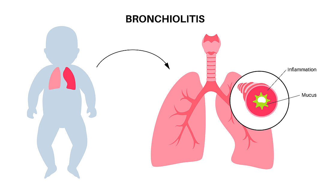 Bronchiolitis lung disease, illustration