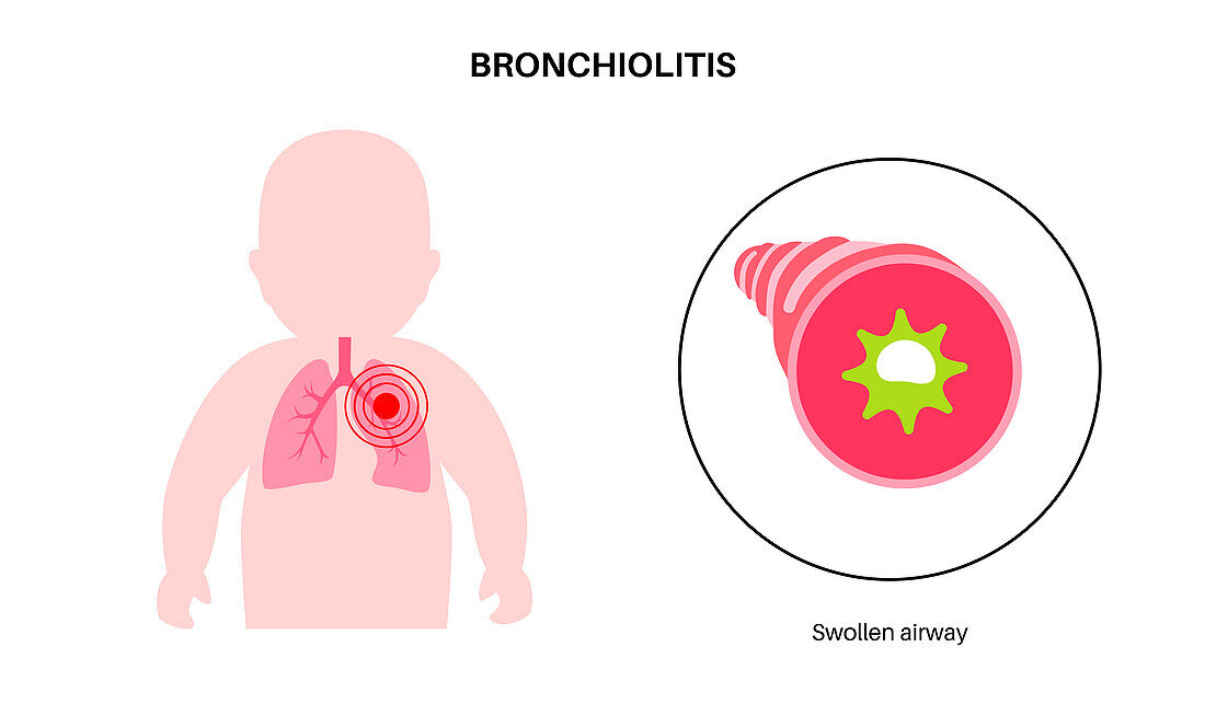 Bronchiolitis lung disease, illustration