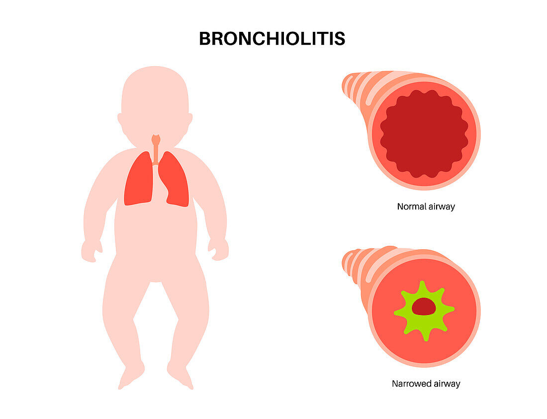 Bronchiolitis lung disease, illustration