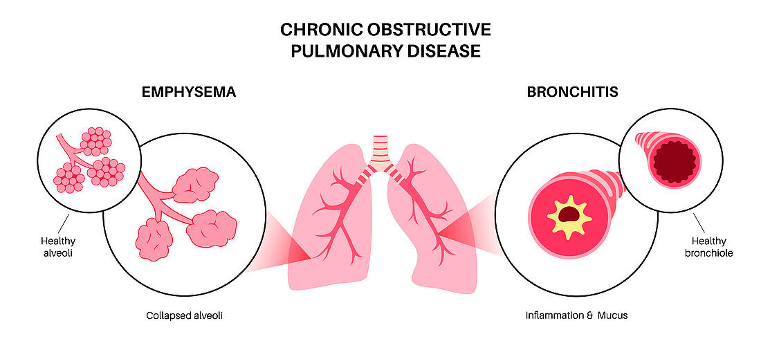 Chronic obstructive pulmonary disease, illustration