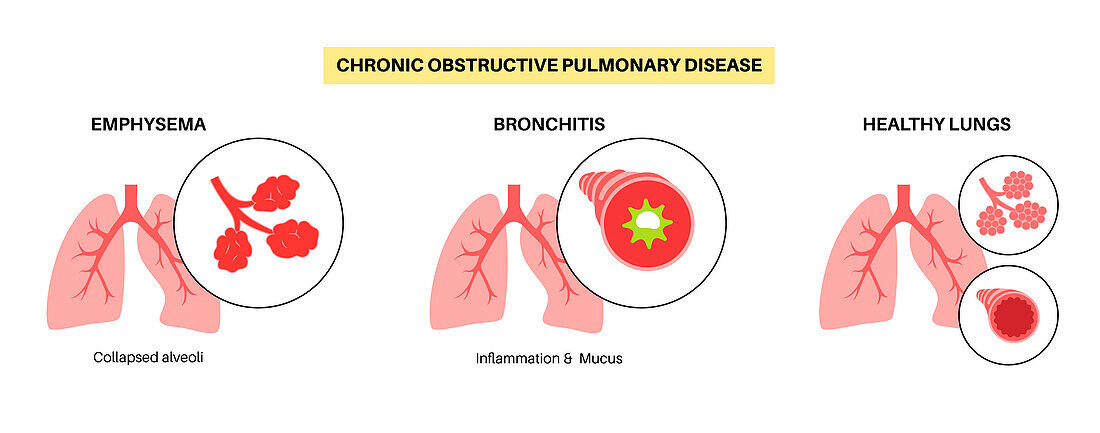 Chronic obstructive pulmonary disease, illustration
