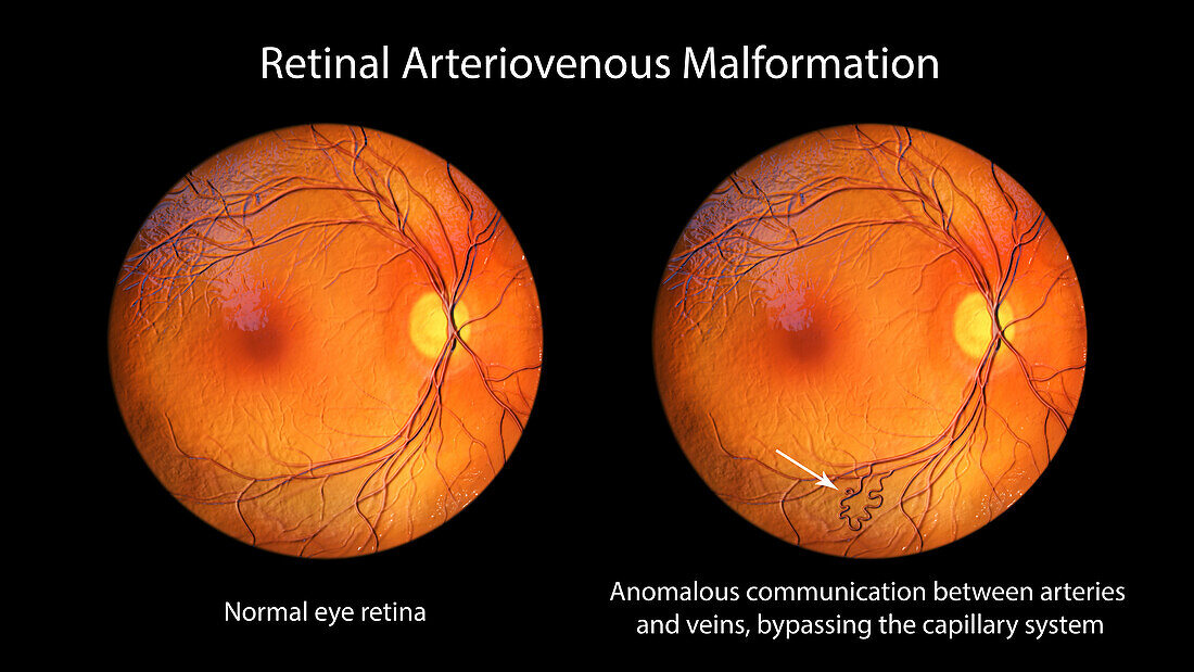 Retinal arteriovenous malformation, illustration