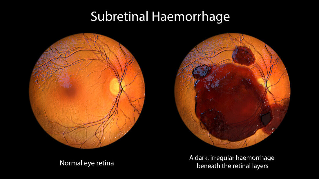 Subretinal haemorrhage on the retina, illustration