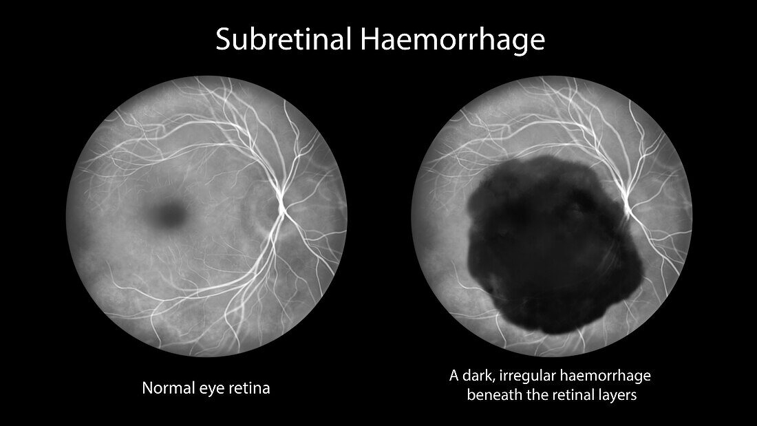 Subretinal haemorrhage on the retina, illustration