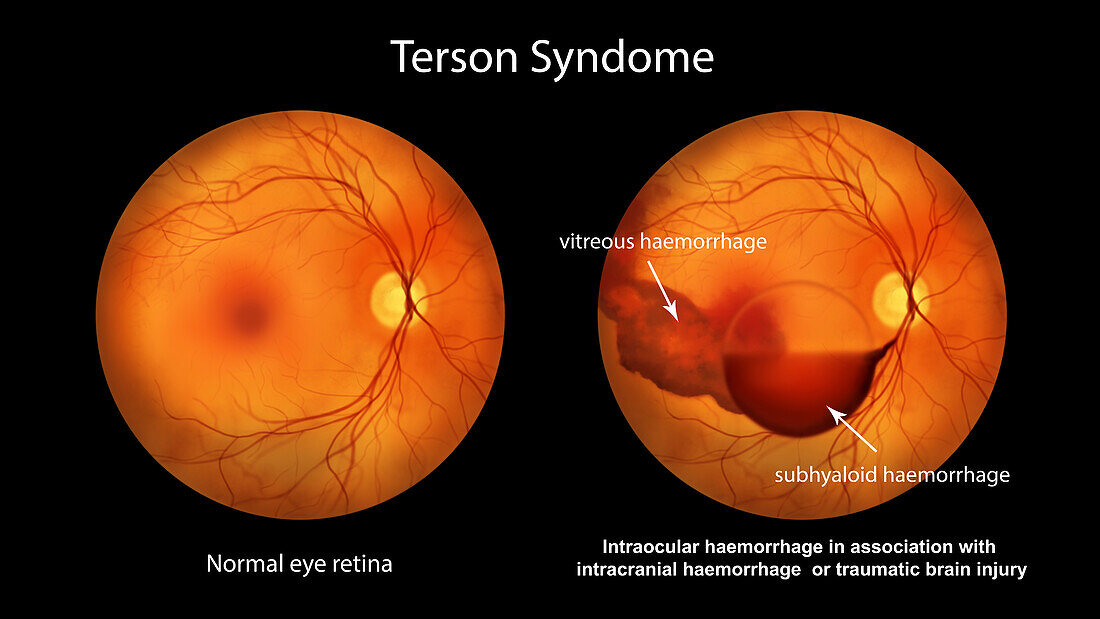 Intraocular haemorrhage in Terson syndrome, illustration