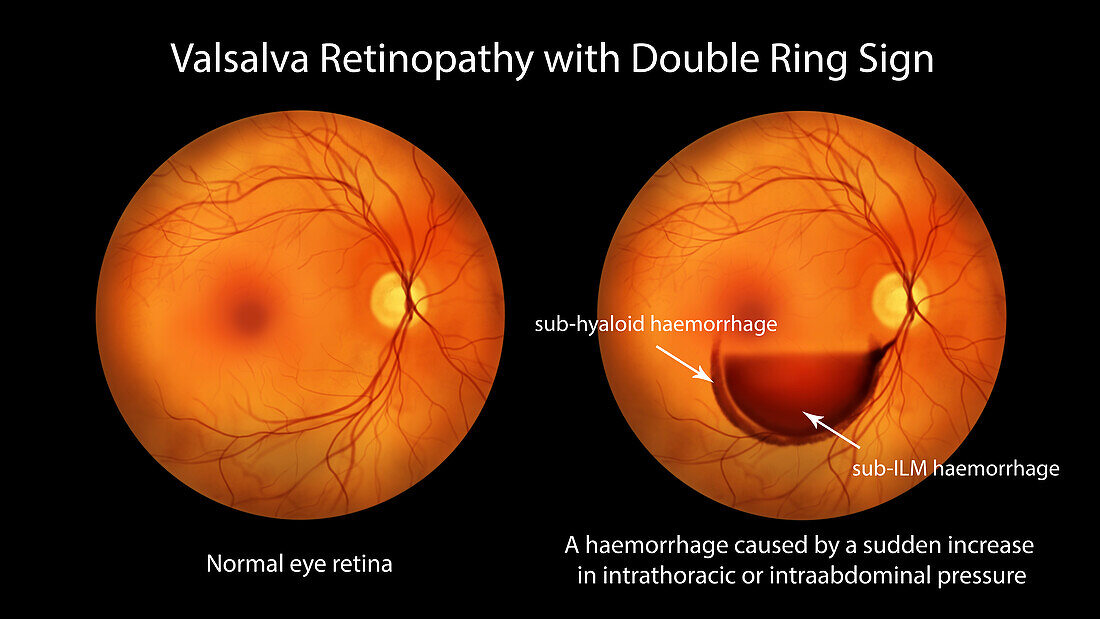 Valsava retinopathy, illustration