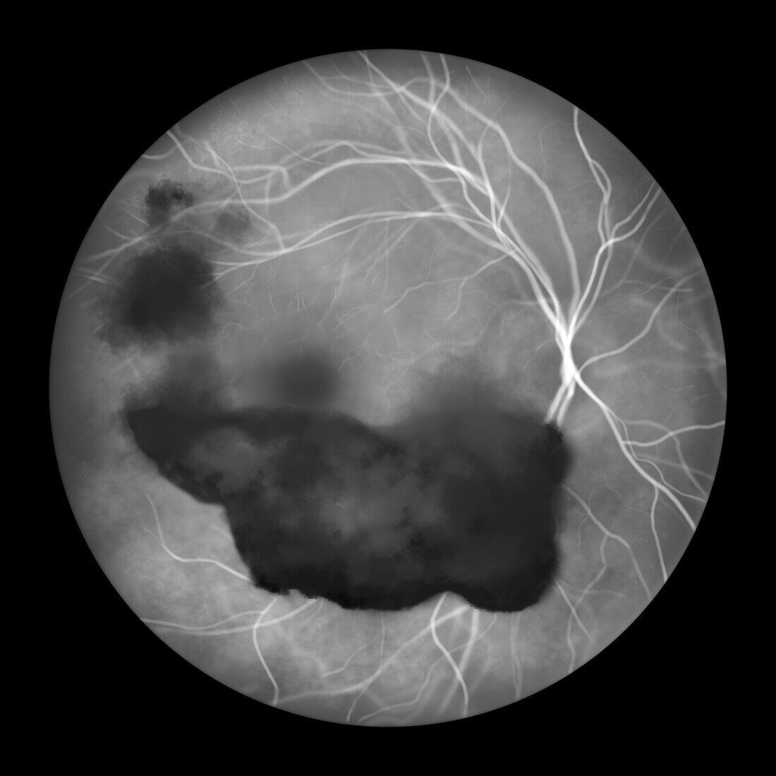 Vitreous haemorrhage, illustration