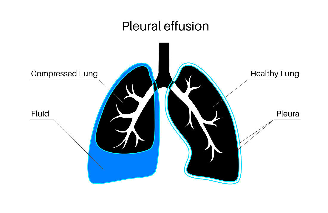 Pleural effusion, illustration