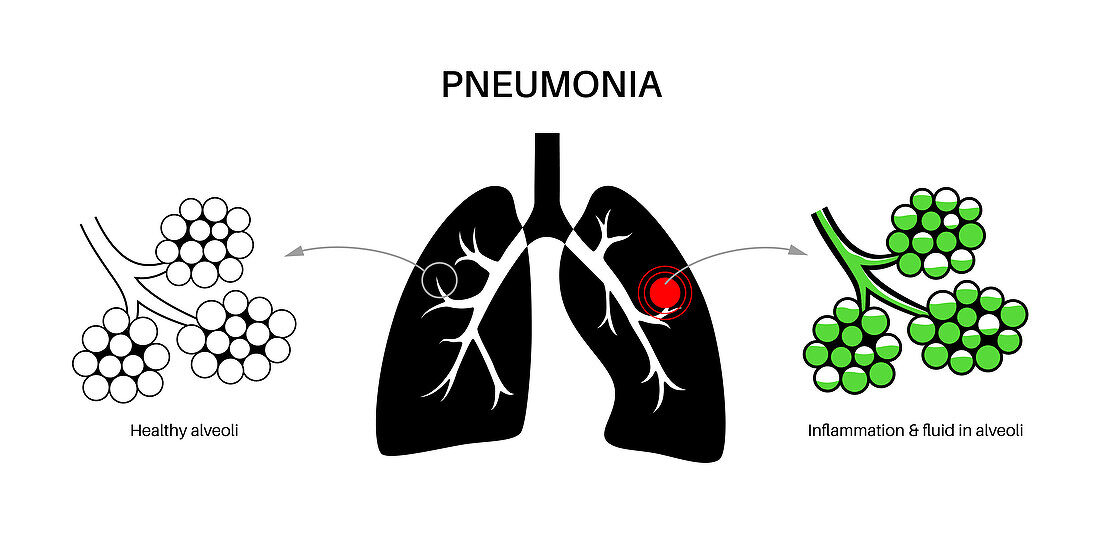 Pneumonia, illustration